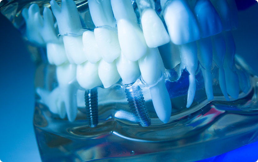 インプラント治療